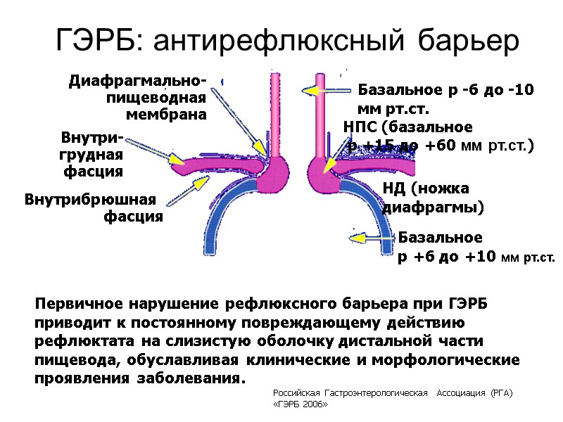 ГЭРБ: антирефлюксный барьер Первичное нарушение рефлюксного барьера при ГЭРБ приводит к постоянному повреждающему действию